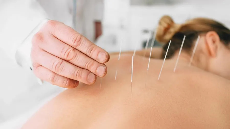 Dry Needling vs Acupuncture: What's the Real Difference?